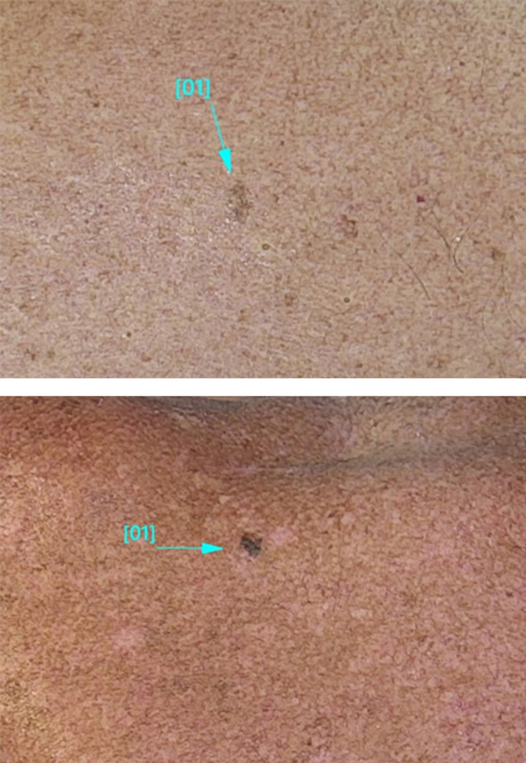 Malignant melanomas on back and trapezius of 2 patients