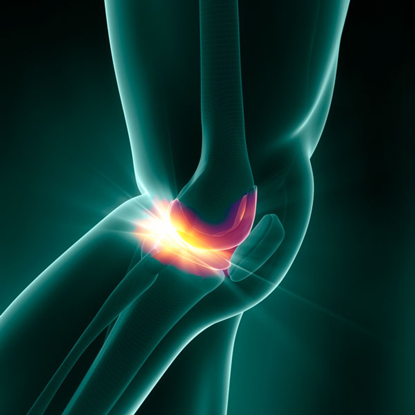 promotional tile for osteoarthritis clinical trial